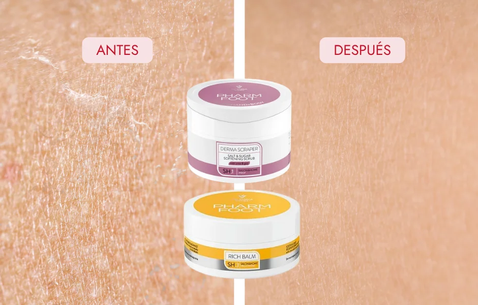imagen de antes y despu&eacute;s de piel seca despu&eacute;s de un tratamiento de Pharm Foot